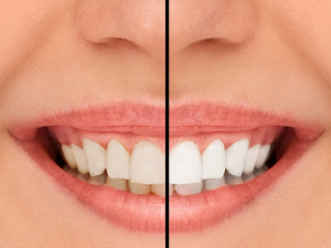 accendiltuosorriso-estetica