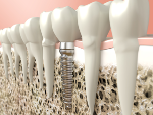 accendiltuosorriso-implantologia