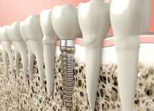 accendiltuosorriso-implantologia-home