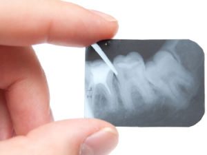 accendiltuosorriso-endodonzia
