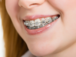 accendiltuosorriso-ortognatodonzia